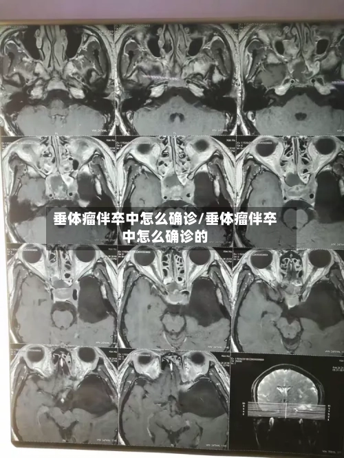 垂体瘤伴卒中怎么确诊/垂体瘤伴卒中怎么确诊的-第2张图片