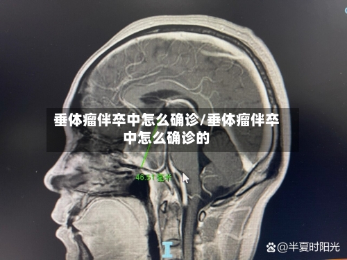 垂体瘤伴卒中怎么确诊/垂体瘤伴卒中怎么确诊的