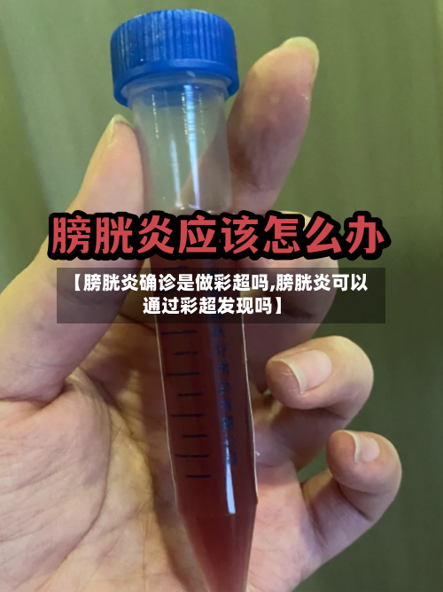 【膀胱炎确诊是做彩超吗,膀胱炎可以通过彩超发现吗】
